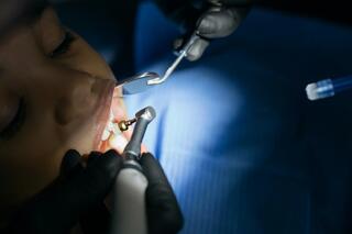 Tartar Removal from Teeth