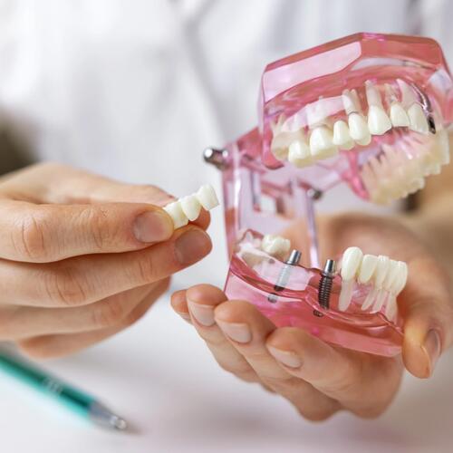 Dental Implant