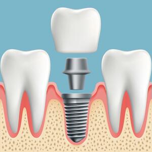 What is a Crown on an Implant and How Does it Look