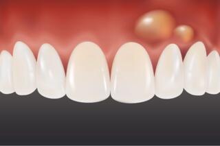 Lump on the Gum