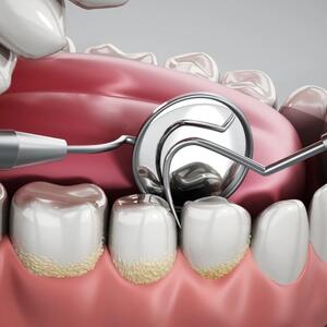 Molar Tooth Implantation