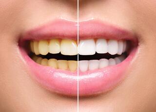 Braces for the Upper Jaw