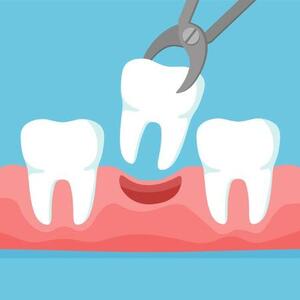 Tooth Extraction