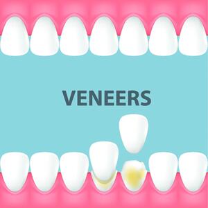 Veneers – What Are They? Types Available, and the Best Options for Your Smile