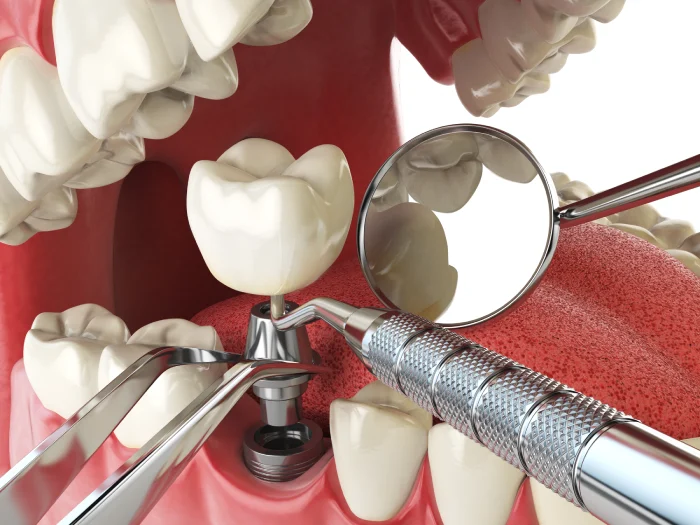 Implantation of Lower Molar Teeth