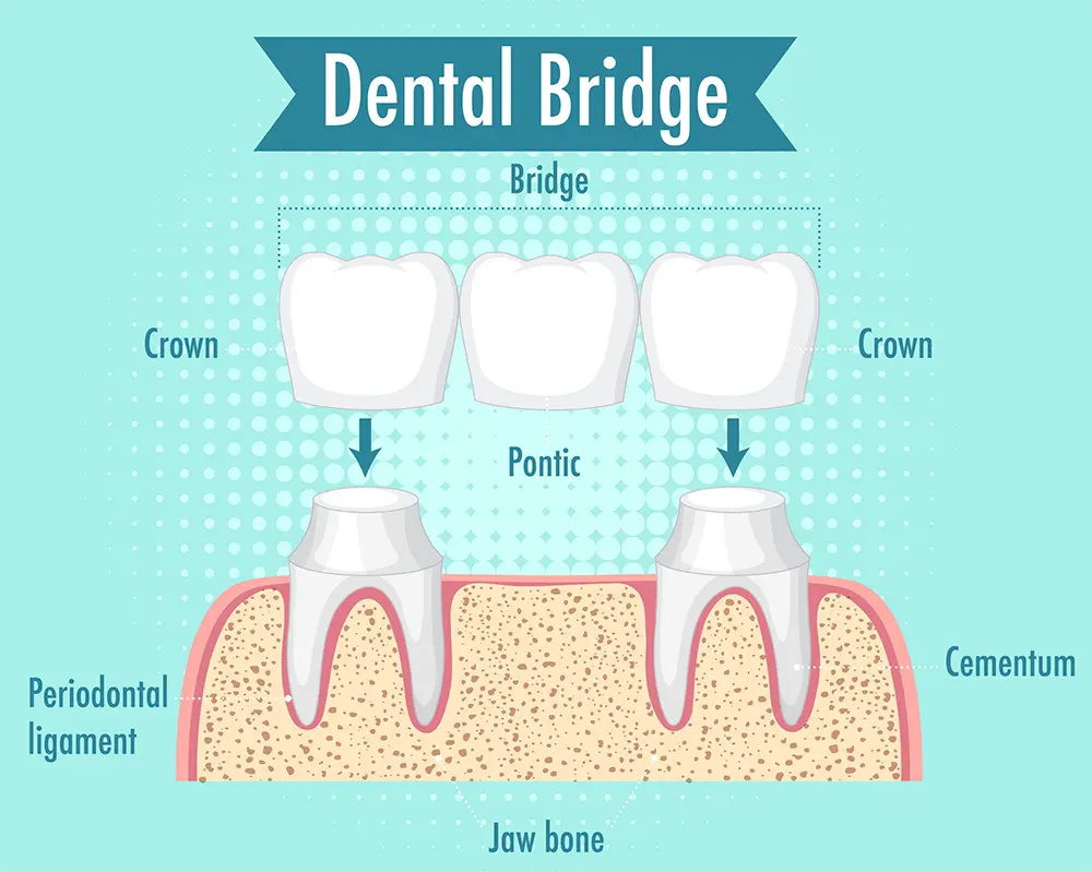 Dental Bridges