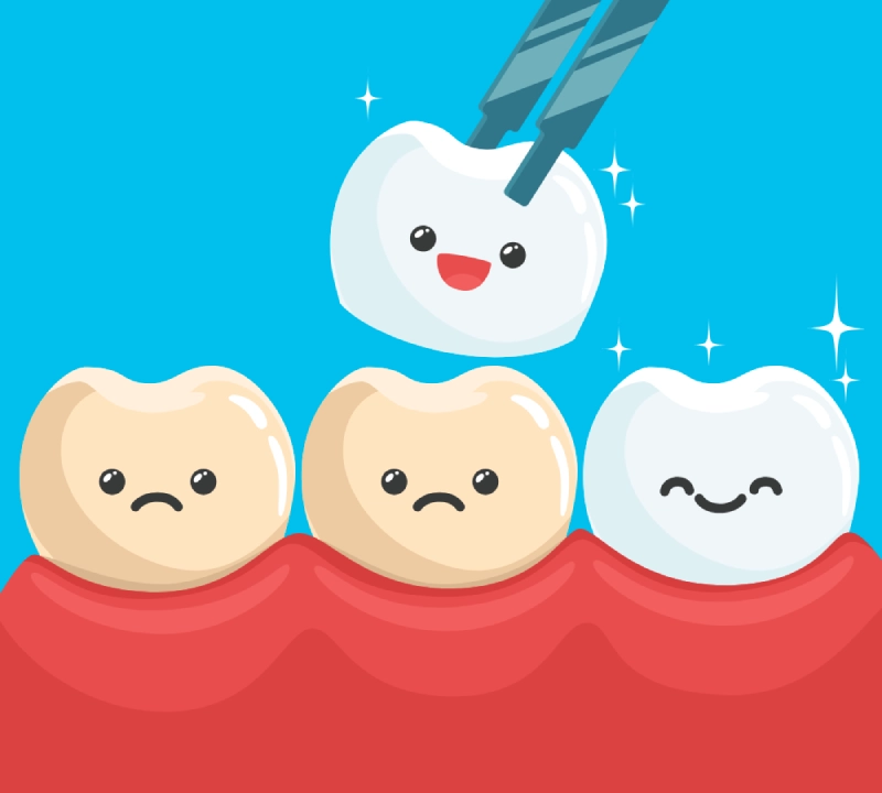 How Veneers Are Placed on Teeth