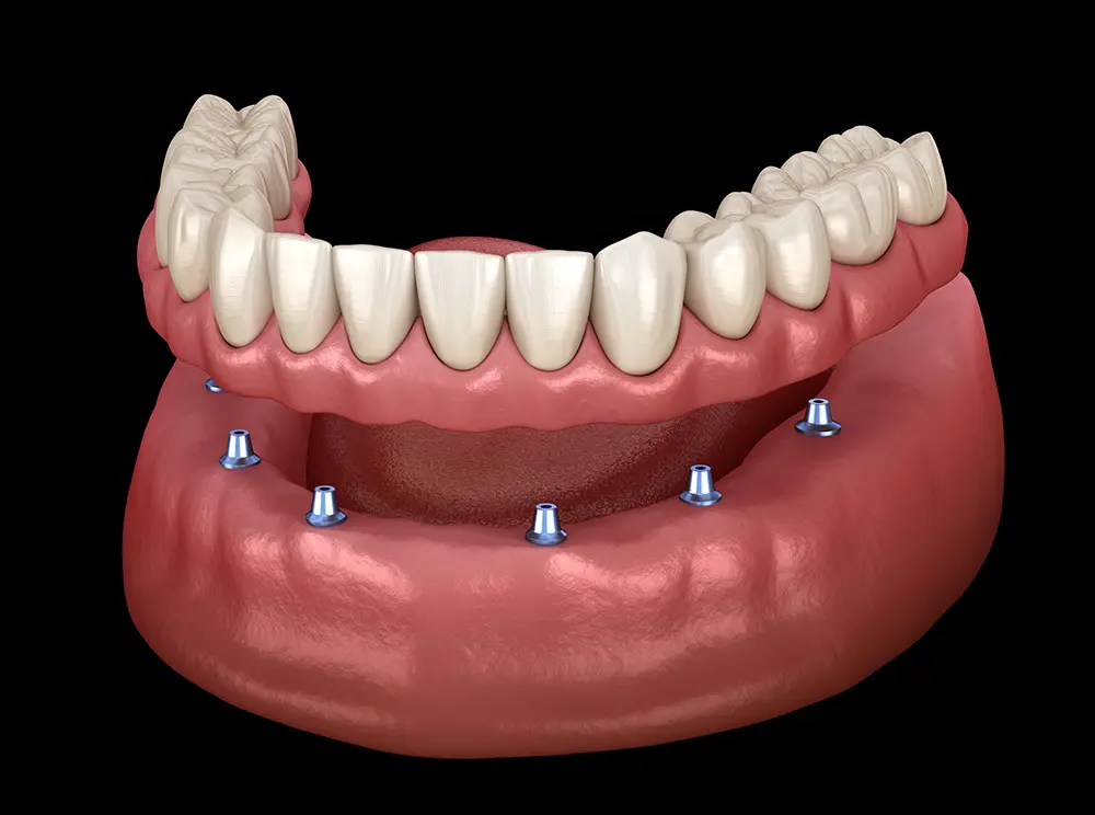 Implant-Supported Overdentures