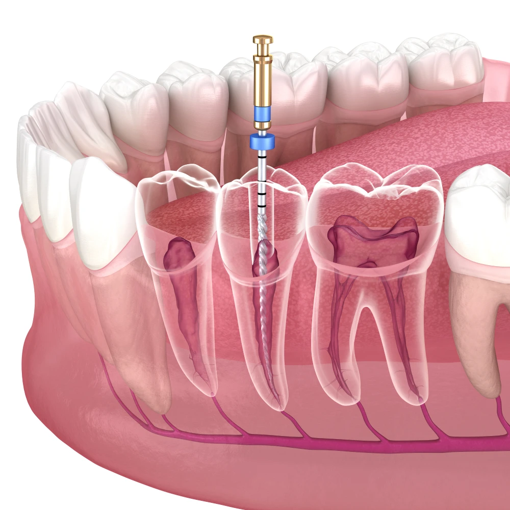 Tooth Nerve Removal – Is It Painful, The Consequences, How the Nerve Is ...