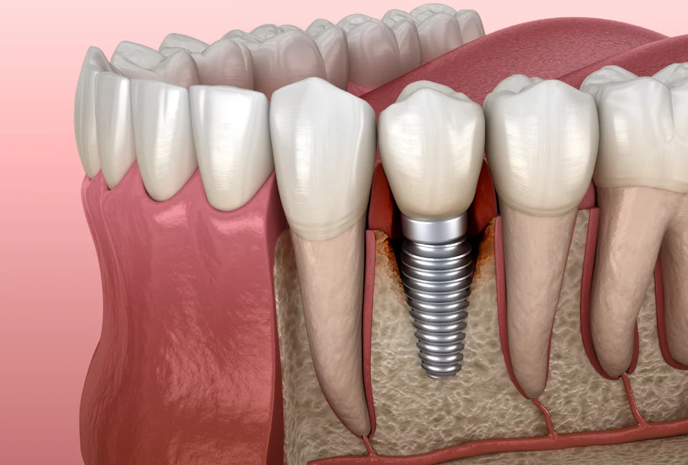 Peri-implantitis