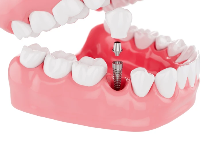 Why a Temporary Crown on an Implant is Necessary