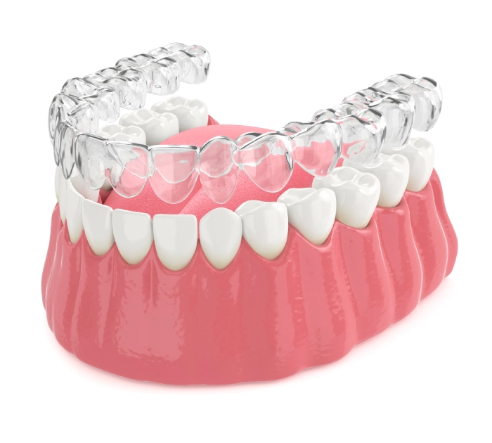 Aligners