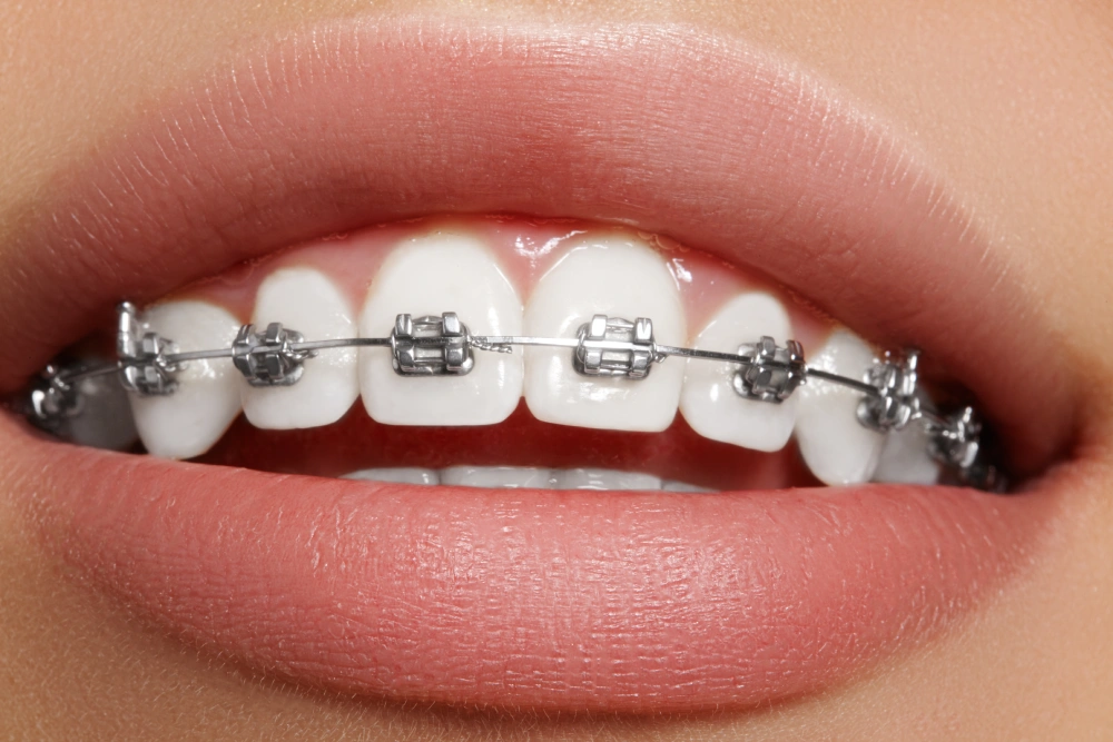 braces