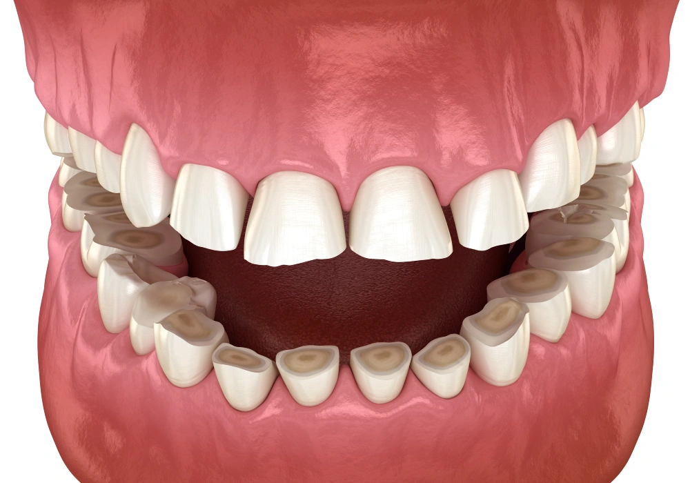 Bruxism