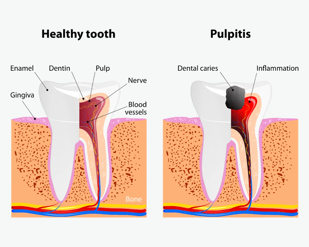 Pulpitis