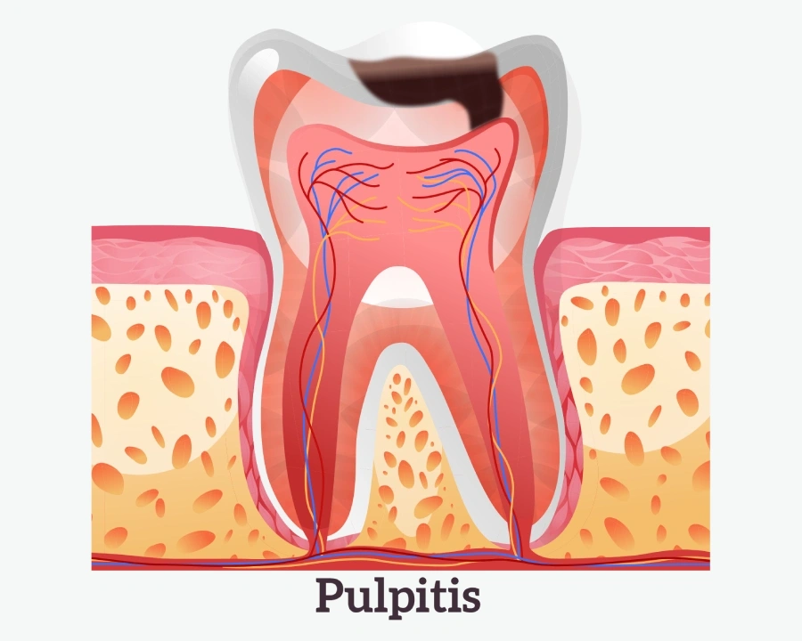 Pulpitis
