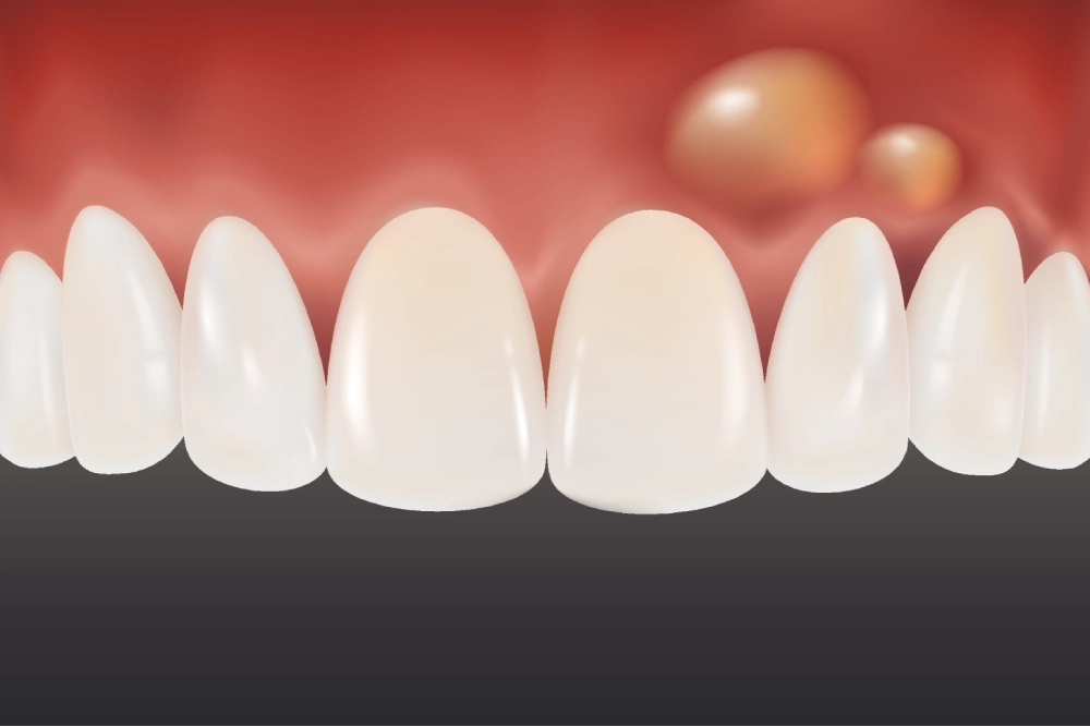Lump on the Gum