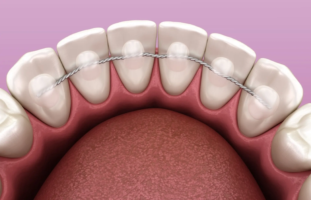 Orthodontic Retainer