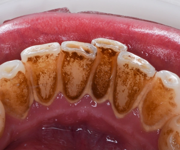 Examples of tartar removal work before