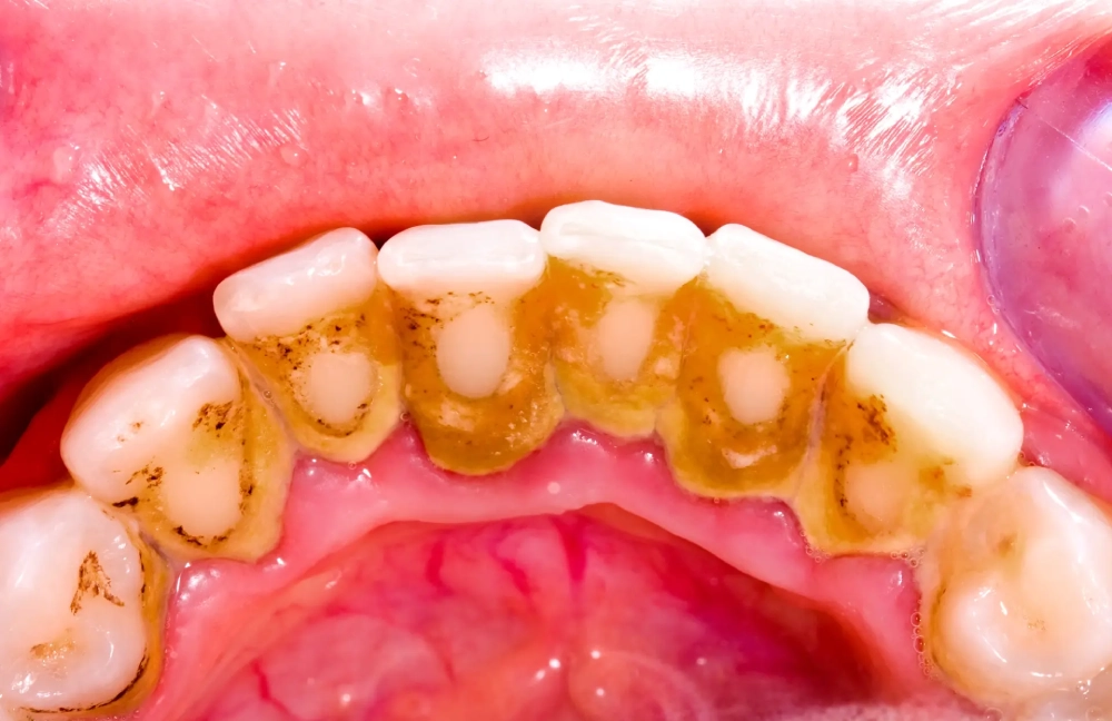 Dental Tartar