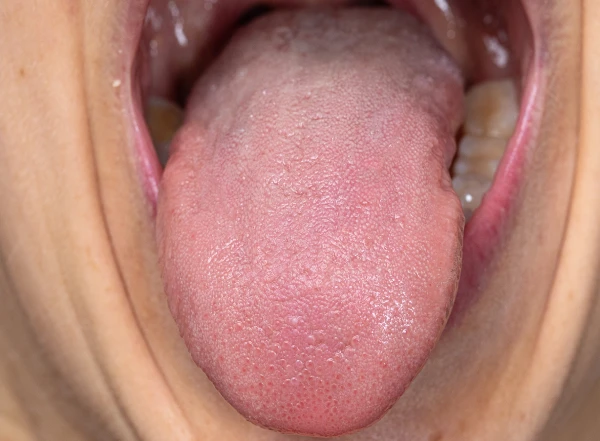 Tongue Coating after