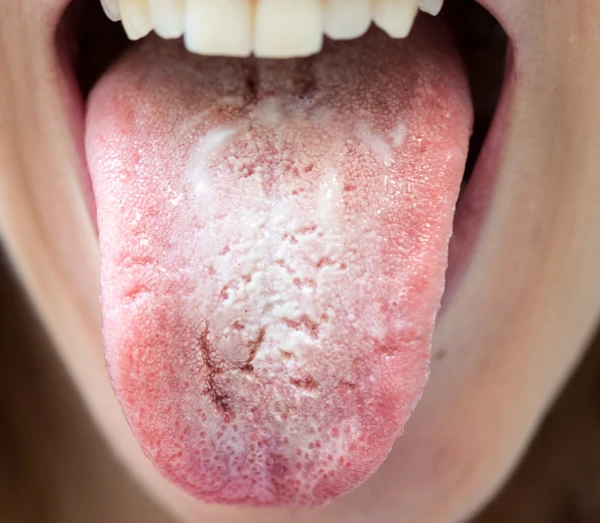 Tongue Coating before