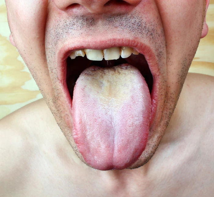 Tongue Coating