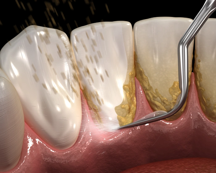 Ultrasonic Dental Cleaning