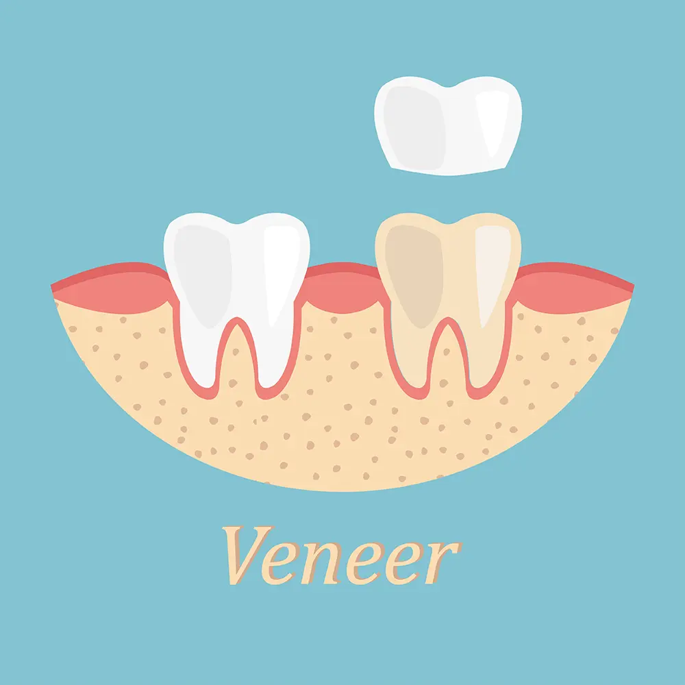 Veneers – What Are They?