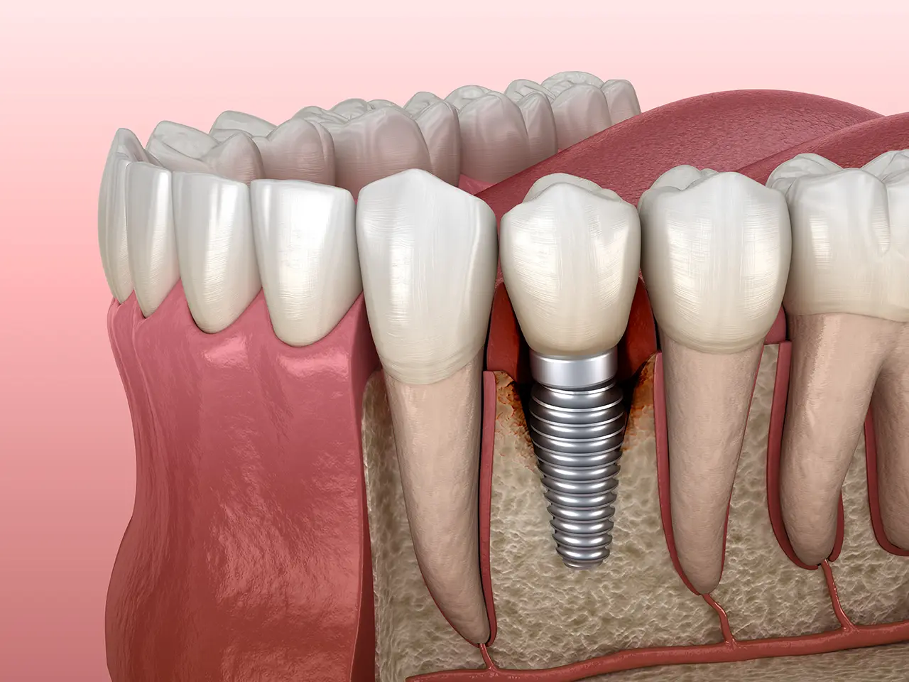 Peri-implantitis